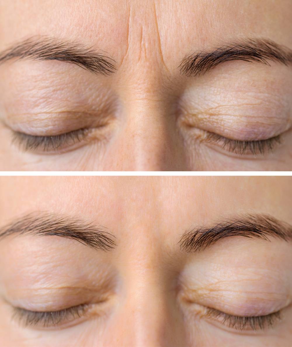 Before and after image showing reduced forehead wrinkles after botox treatment, highlighting visible anti-aging results.