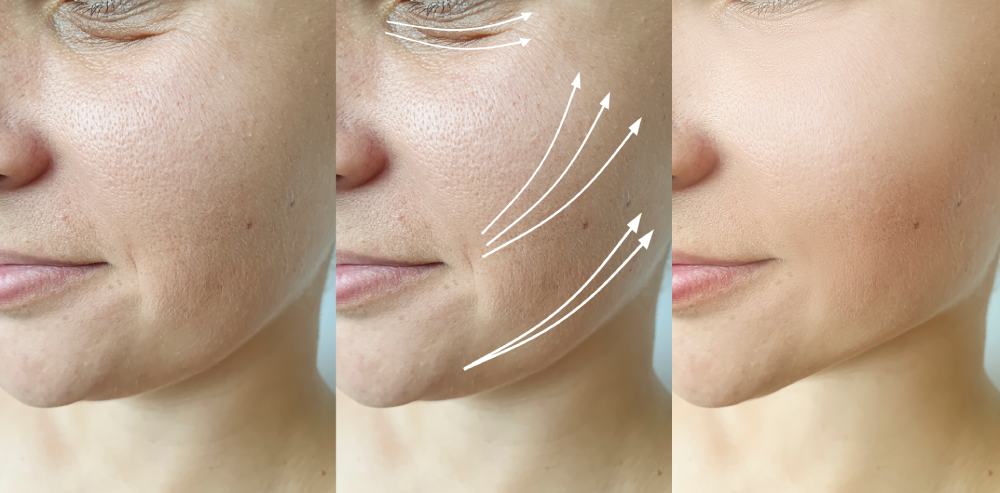 Before and after results of facial lifting with PDO threads.
