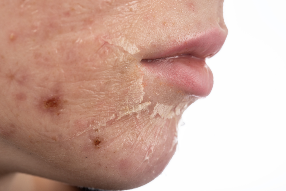 Close-up of skin peeling and acne scarring after chemical peels.