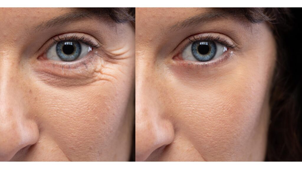 Injectables used for under-eye wrinkle reduction