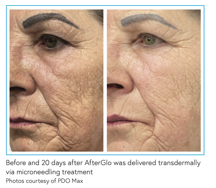 MicroneedlingBeforeAfterPDOAfterGlo