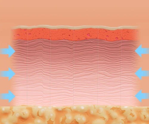 Ellacor Treatment
