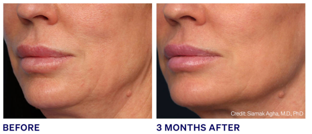 loose skin after weight loss treated with Ellacor